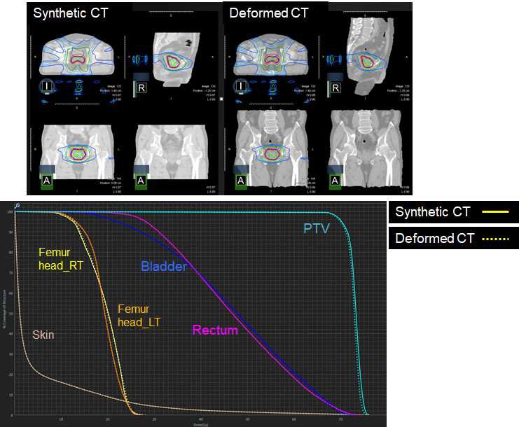 합성CT와 변형CT을 사용한 치료계획에서의 선량체적히스토그램 비교 (전립선암)
