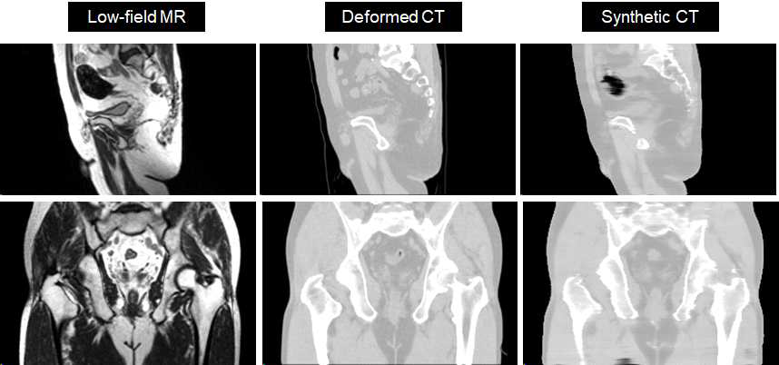 Coronal 및 Sagittal 단면에서의 변형 CT와 합성 CT의 비교