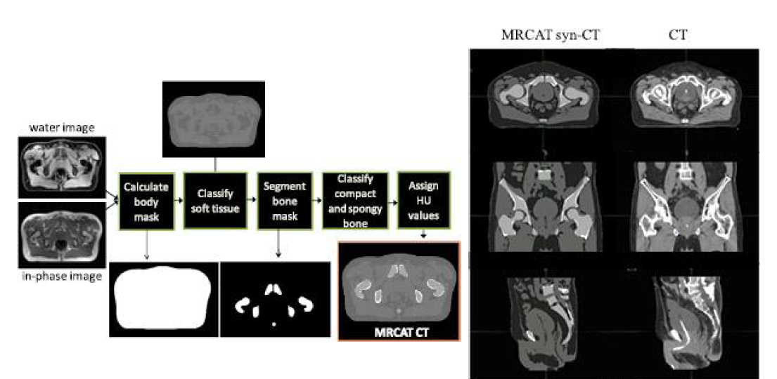 MRCAT 합성CT 생성 개념도(좌) 및 합성CT 및 원 CT 비교 (우)