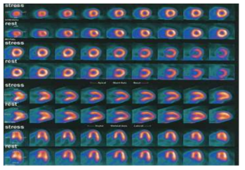 Sr-82/ Rb-82를 이용한 심근경색 진단 이미지 예시 (출처: J Am Coll Cardiol. 2007;49(10):1052-1058)