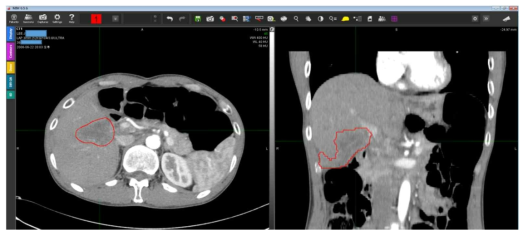 데이터베이스 중 Liver0009 환자의 CT에 간 조직을 도식화하고, 빨간색으로 표기함 (그림 24와 같은 환자의 CT)