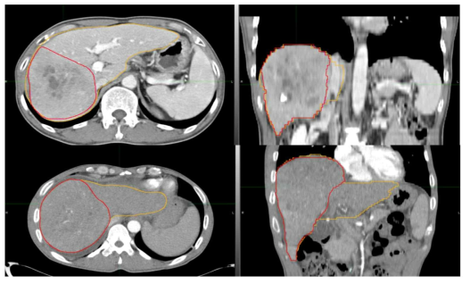 다른 환자의 CT 영상에도 간암조직(빨간색), 정상간조직(노란색)을 도식화하여 향후 간암의 예후예측을 위한 기본 데이터로 준비함