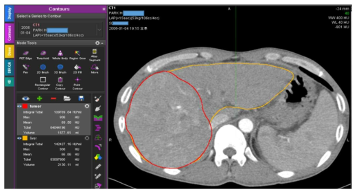 MIM SW를 활용하여 도식화된 contour들에 대한 영상의 기본적인 parameter들에 대한 정보를 확인함. 기본적으로 HU 값에 의한 정보와 전체 크기에 대한 정보는 쉽게 파악이 가능함