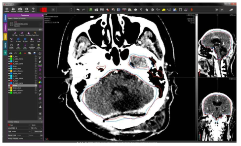 Atlas based auto segmentation을 통해 그려진 Head & Neck 환자의 contour비교. 자동으로 그린 contour(Red)와 의사가 그린 contour(Blue)의 비교