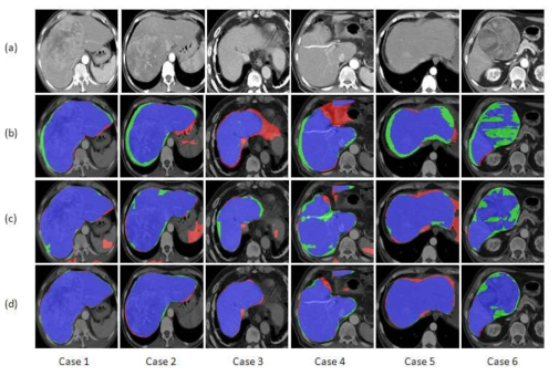 복부 CT 영상에서 정상조직 간 분할 결과: (a) 원본 영상, (b) 2.5D 네트워크 적용 결과, (c) 확률맵을 고려하지 않은 제안방법 적용 결과, (d) 확률맵을 고려한 제안 방법 적용 결과 (Blue: True Positive, Red: False Positive, Green: False Negative)