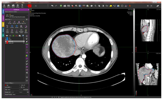 Liver – match가 잘 된 경우