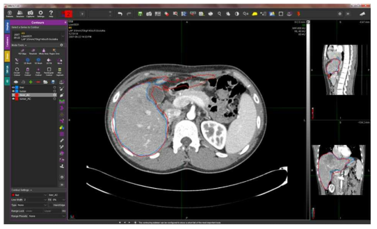 Liver – Over-segmentation 한 경우 (오차 적음)