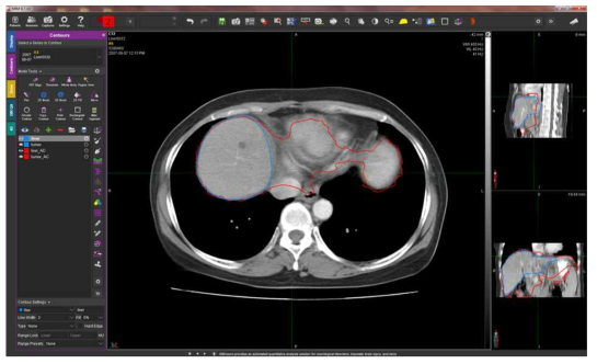 Liver – Over-segmentation 한 경우 (오차 큼)