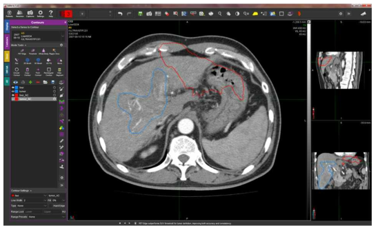 Tumor – 잘못된 segmentation