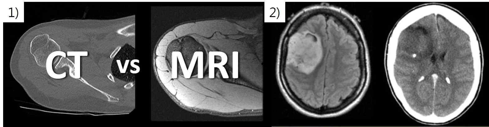 1) CT에 비해 MR영상은 연부조직의 대조능이 높음, 2) CT영상에서 명확하게 정의 되지 않은 뇌종양(우)을 MR영상에서는 정확하게 정의할 수 있음(좌)