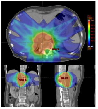 환자 CT영상에 계산된 방사선량 분포