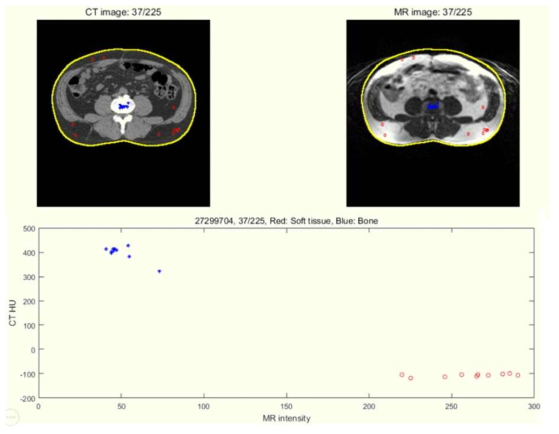 CT 영상에서 뼈 / 뼈 이외의 영역에서 추출해 낸 안정된 화소들과 동일한 위치에서 MR 화소값간의 관계를 나타내는 그래프