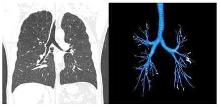 흉부 CT 영상(왼쪽)과 기관지 AI 분석 결과(오른쪽)