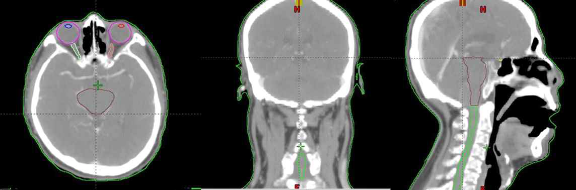 환자 CT에 정의된 정상 장기 윤곽정보(안구, 수정체, 시신경, 뇌간, 척수가 정의되어 있음)
