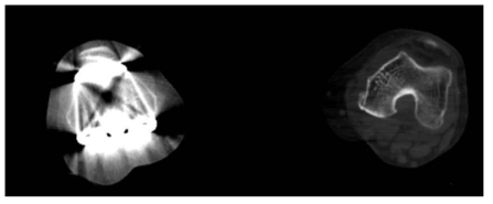 무릎 관절에 보형물이 삽입된 경우의 CT 영상 (O-MAR 적용 전)