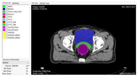 전립선암 환자의 CT 영상 및 방사선 치료계획 예시 (파란색: 방광, 연두색: 전립선 치료 부위, 분홍색: 직장)