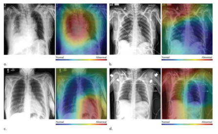 환자 chest X-ray를 활용한 자동진단 네트워크
