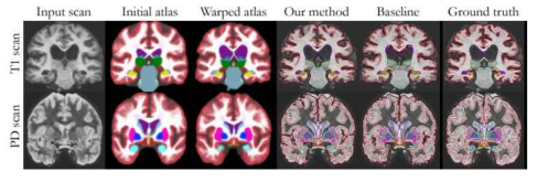 Unsupervised brain MRI segmentation