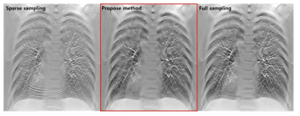 Sparse sampling으로 획득한 저화질의 재구성 영상 (좌), 개발한 딥러닝 기반의 재구성 기술로 Sparse sampling 조건에서 재구성한 영상 (중), Full sampling으로 재구성한 영상 (우)