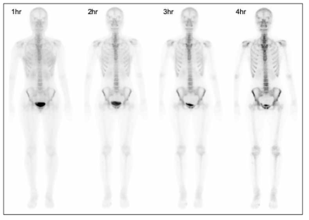 뼈스캔용 방사성의약품 주사 후 시간에 따른 뼈스캔 영상 변화