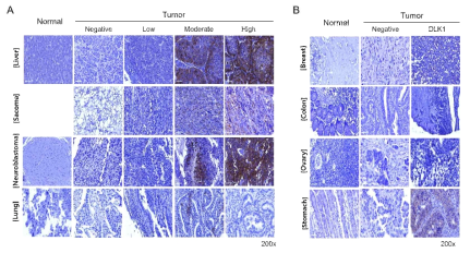 DLK1 IHC용 개발 항체 7C7을 이용한 인간 암조직에서 DLK1 발현 확인