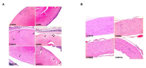 DLK1-SA0986-MMAE(DAR4) ADC 마우스 단회 투여에 의한 수정체(A) 및 좌골신경섬유(B)의 조직병리학적 특징