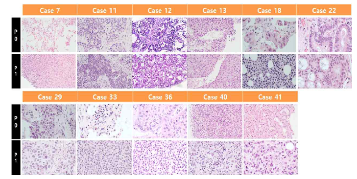 폐암 조직 Histology 비교한 H&E 사진