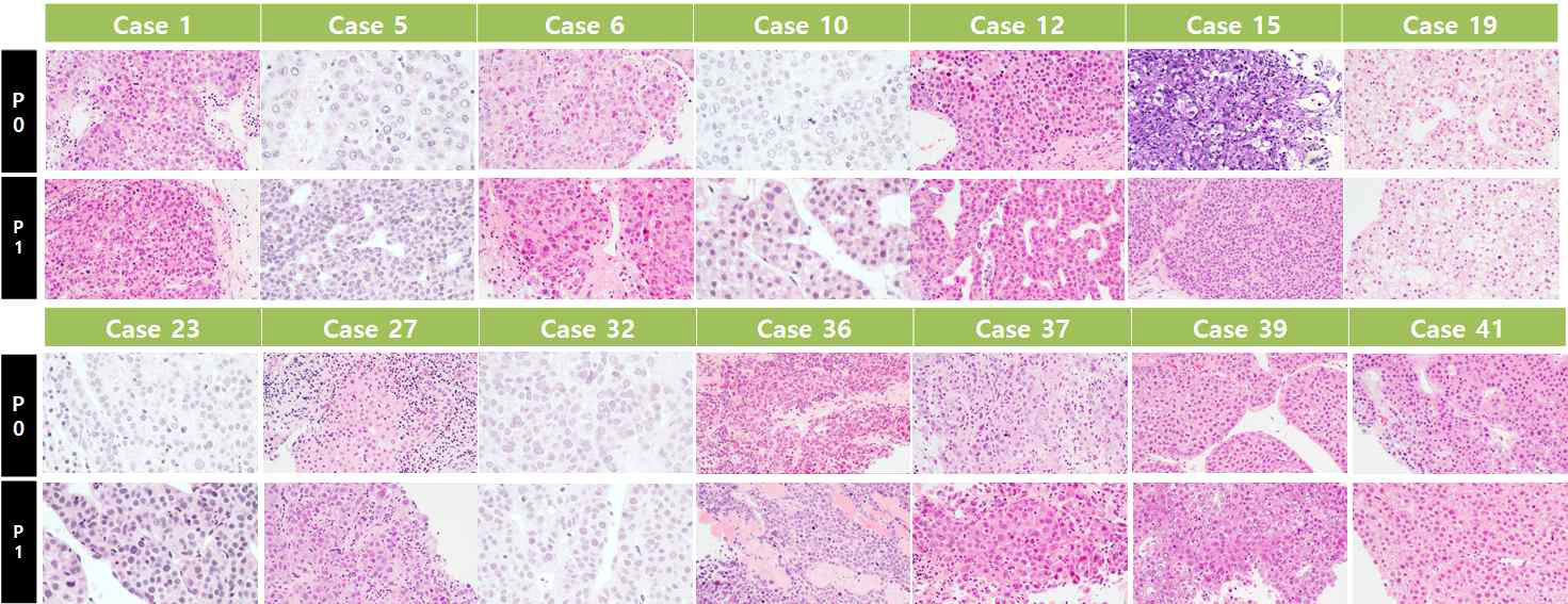 간암 조직 Histology 비교한 H&E 사진