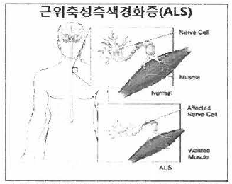 ALS에서의 운동신경섬유 및 금육위축