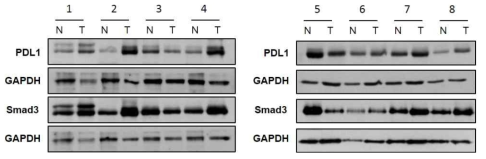 위암환자 조직에서 Smad3와 PDL1의 발현확인