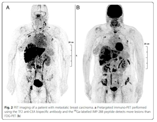 유방암 전이 환자의 FDG-PET (오른쪽)과 pretargeting 방법을 이용한 PET 영상 (왼쪽)