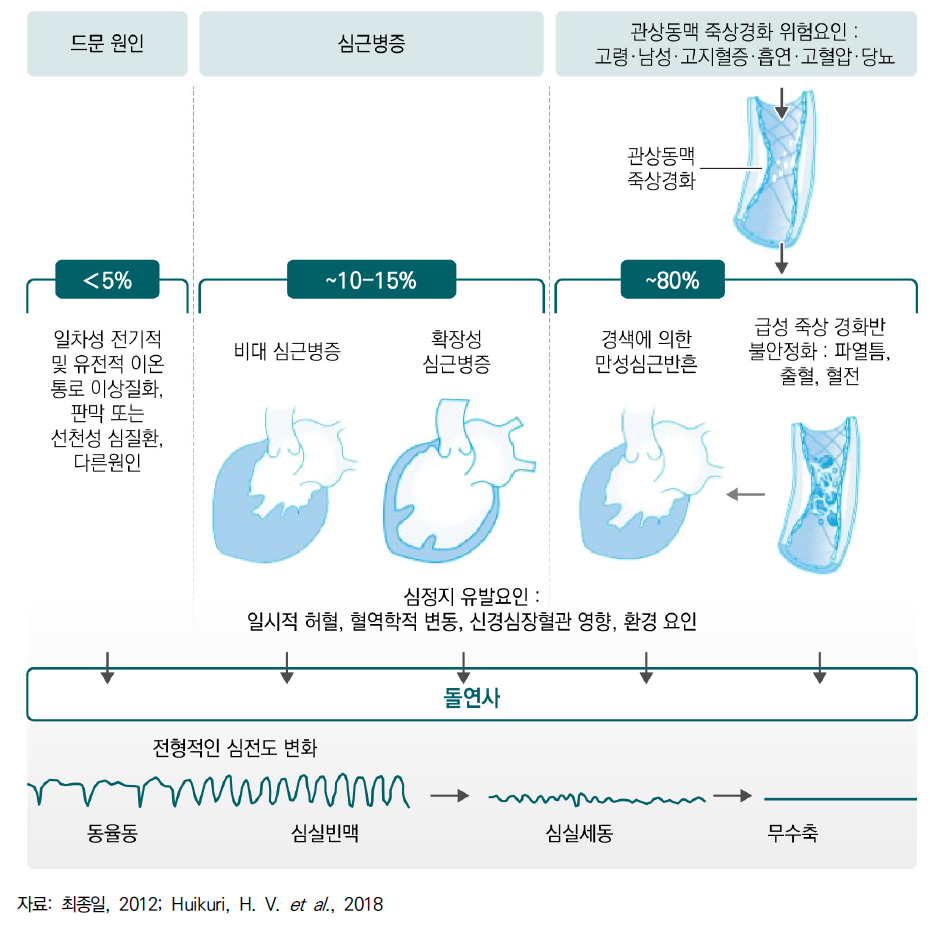 돌연심장마비 또는 급사의 주요 원인