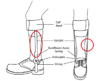 족관절-발 보조기 개념도