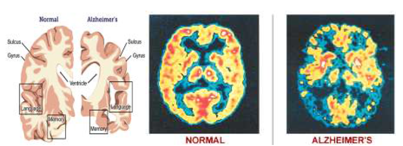건강한 사람과 알츠하이머병 환자의 뇌 구조 비교