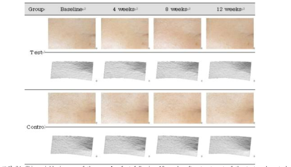 Skin wrinkle images of the crow’s feet following 12 weeks after treatment of the test and control products (Upper: standard optical image, lower: 3D image, Ref. Subject #01 (Test group), #11 (Control group))