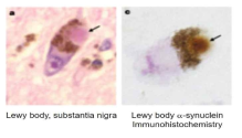 파킨슨 뇌에 축적된 Lewy body. 특히 오른쪽 이미지는 Lewy body 내 α -synuclein 의 존재를 보여줌