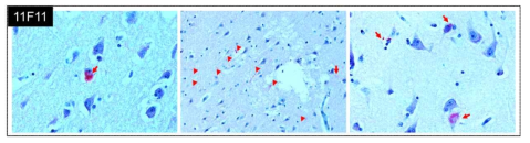 파킨슨 병 환자의 사후 뇌조직에 대한 11F11 선도항체의 결합 분석. 화살표는 항체에 의해 염색된 Lewy body를 의미하며 꼬리 없는 화살표는 Lewy neurite를 의미함