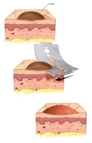 표층생검 절차