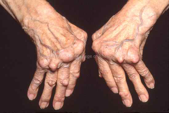 Rheumatoid arthritis 사례