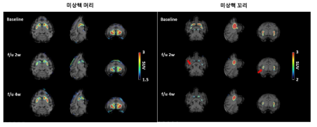 도파민 손상 MR 기반 PET(양전자 방출 단층촬영) 이미징 MR 촬영 이미지와 PET 촬영 이미지를 동시에 분석하여, 도파민 뉴런 손상 물질 주입 후 미상핵의 머리 부분과 미상핵의 꼬리 부분에서 도파민 전달 물질의 활성이 억제된 것을 확인할 수 있음