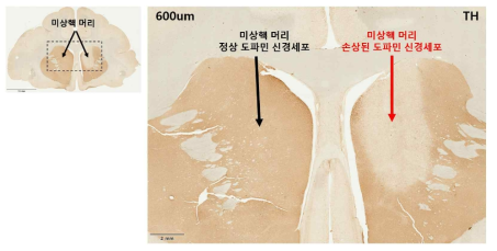 타이로신 수산화효소 면역 염색 미상핵 머리 부분 도파민 입력 손상 모델의 뇌 조직을 이용해 타이로신 수산화효소의 항체 면역 염색 결과 주입 부위에서 약물을 주입하지 않은 영역(좌측 검은색 화살표 영역)에 비해 도파민 신경 세포의 분명한 세포 사멸(우측 빨간색 화살표 영역)이 관찰됨