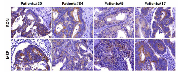 대장암 환자 조직에서 RON&MSP모두 3+인 cases들에 대한 대표적인 결과
