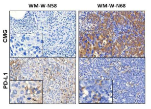 비소세포암환자 조직에서 CMG와 PD-L1에 대한 대표적인 결과