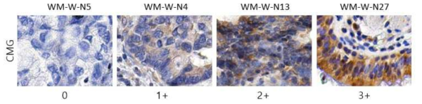 비소세포암환자 조직에서 CMG 양성인 case에 대한 대표적인 결과