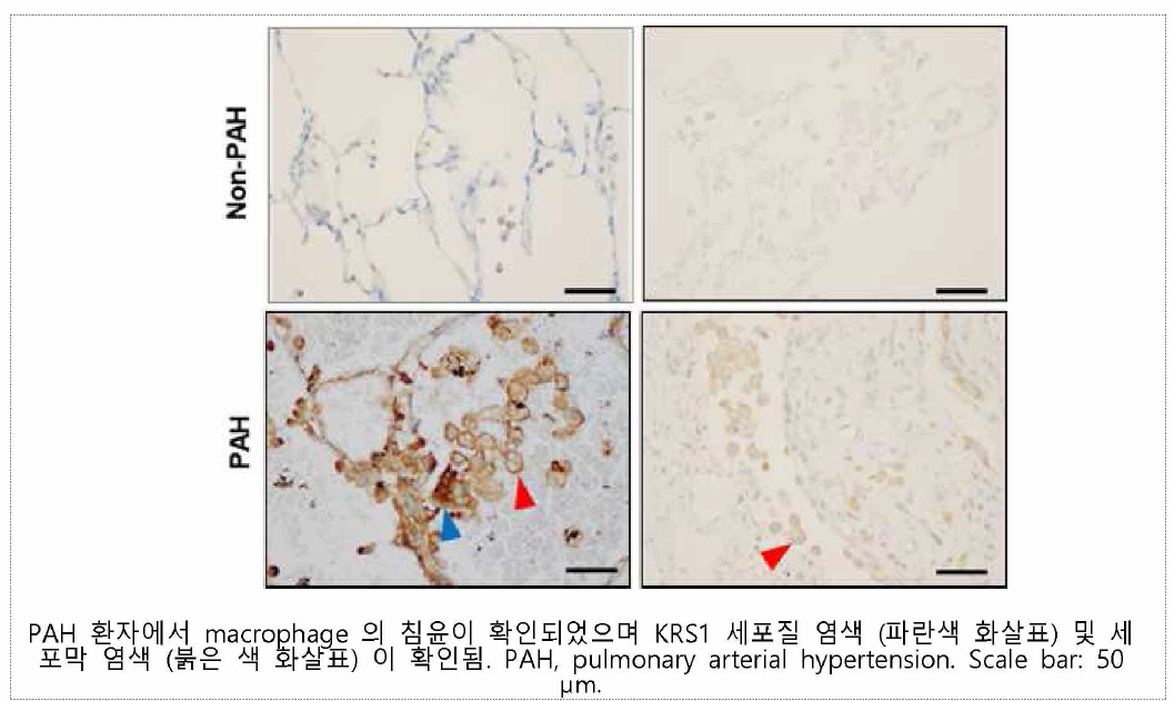 N3-9ML 항체를 이용한 KRS으I 환자 폐조직에서의 염색 패턴