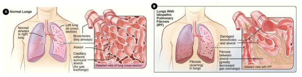 정상 폐조직과 폐섬유증 폐조직의 조직병리학적 차이점