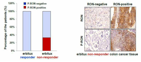 Erbitux 저항성을 보이는 환자 샘플에서 pRON 발현 확인