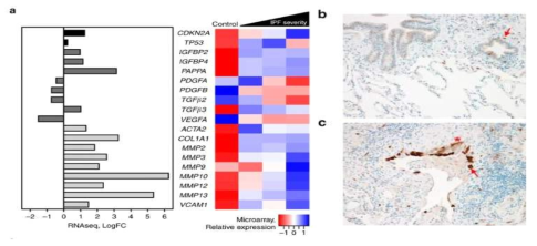 IPF의 RNA-seq 결과 및 IHC 결과