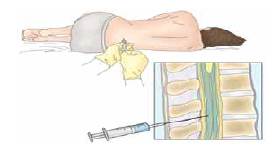 척수천자 검사법