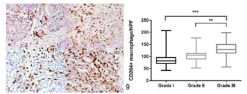 CD204발현 macrophage의 grade별 비교 IHC사진 및 정리 그래프